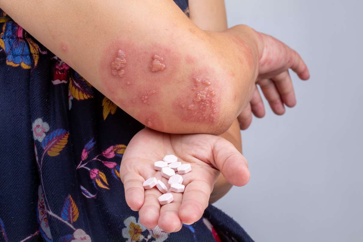 scabbia scabbia italia sintomi