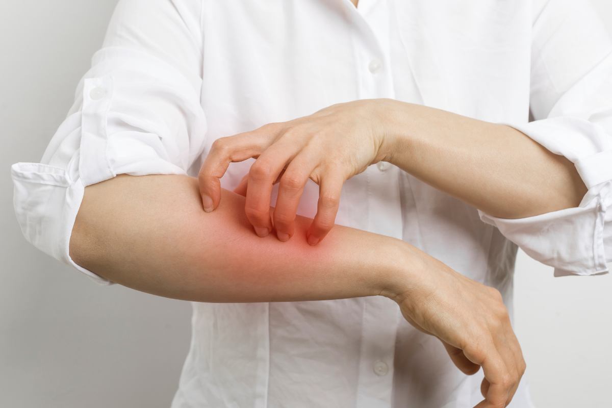 epidema scabbia italia